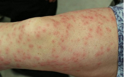 بیماری سرخجه در بارداری و علائم آن بیماری سرخجه در بارداری و علائم آن