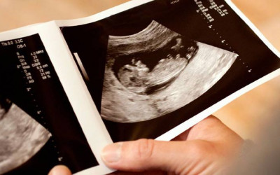 بررسی اندازه طول ران یا FI در سونوگرافی جنین چیست؟