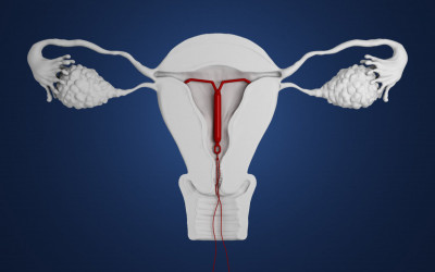 نحوه عملکرد آی یو دی و مزایا و معایب آن