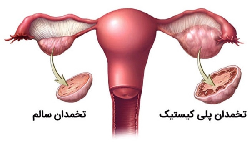 سندروم تخمدان پلی کیستیک در بارداری