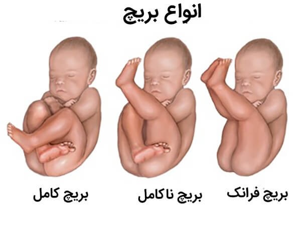 انواع بریچ