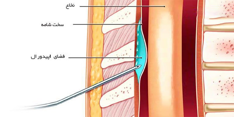 بی حسی اپیدورال برای زایمان بدون درد