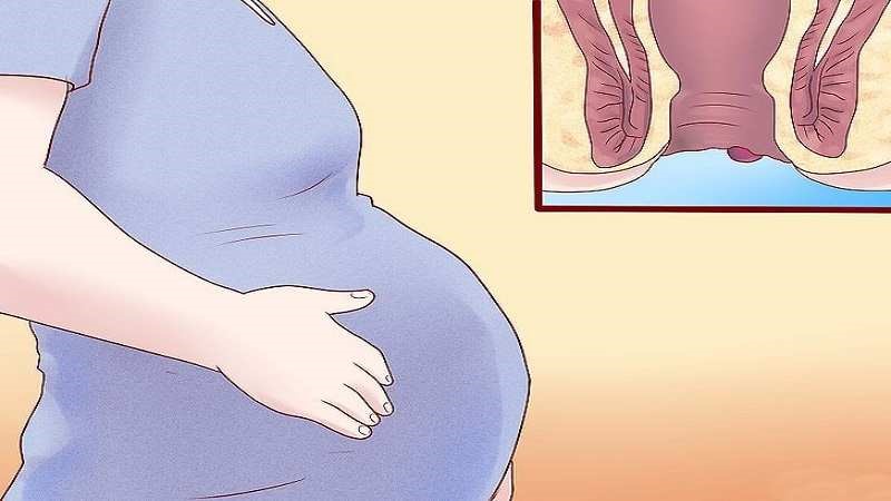  هموروئید در بارداری